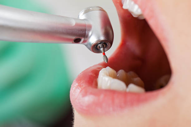 Best Knocked-Out Tooth (Avulsed Tooth) Treatment in Shreve, OH